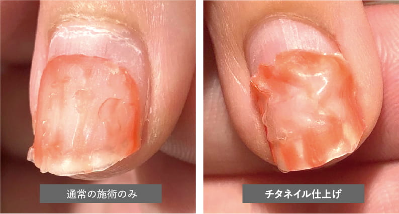 チタネイルプロ使用比較